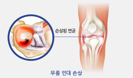 손상된 연골 - 무릎 인대 손상
