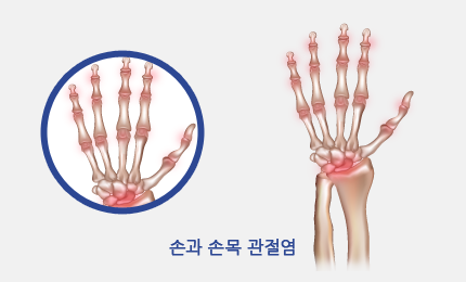 손과 손목 관절염